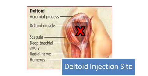 site injections for steroids